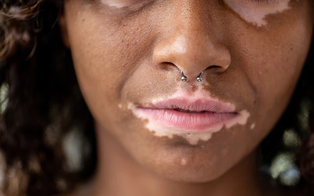 Mucosal Vitiligo