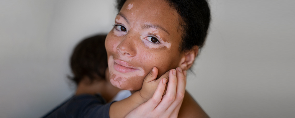 Segmental Vitiligo